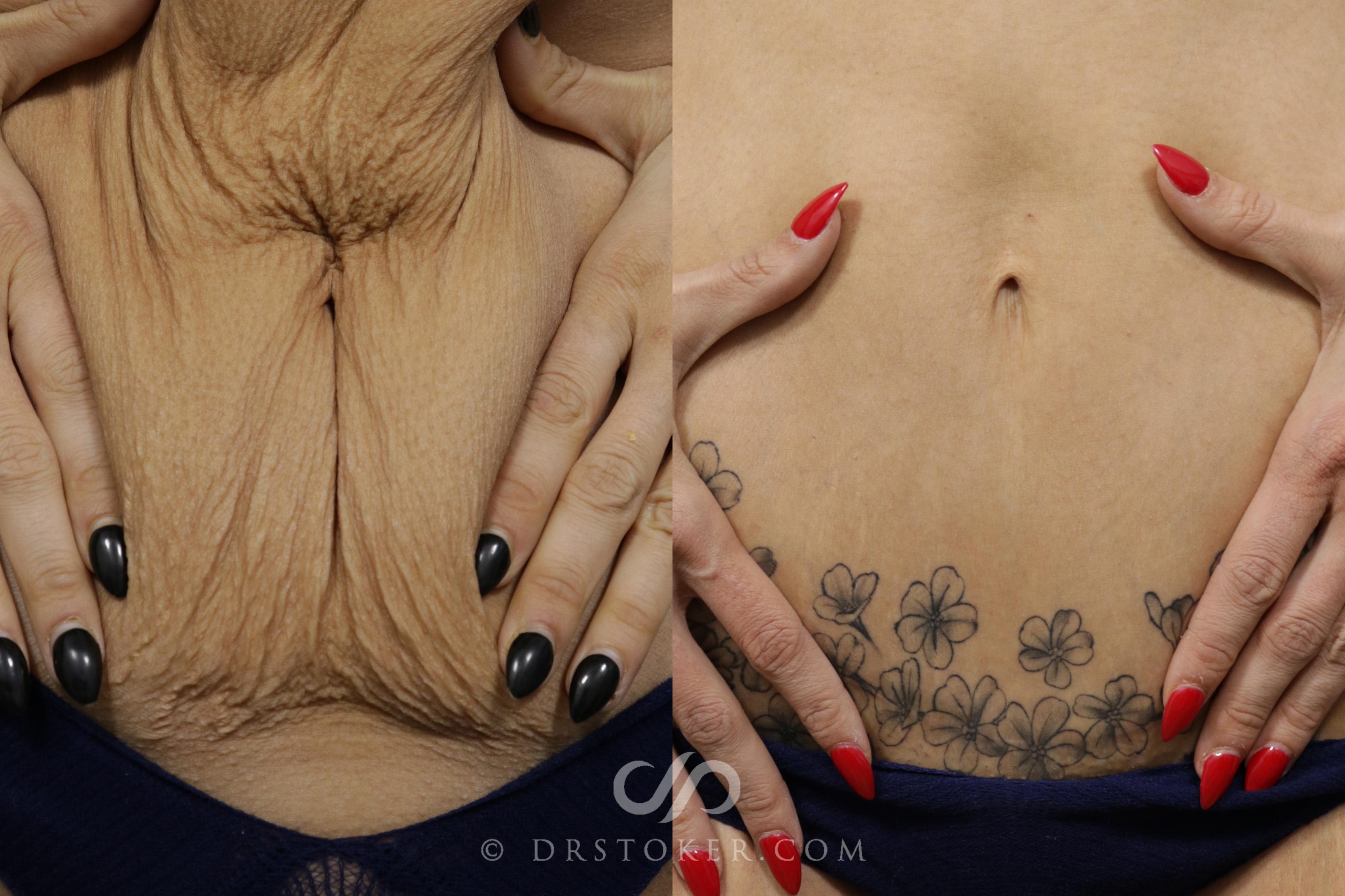 stomach tattoos to cover tummy tuck scar