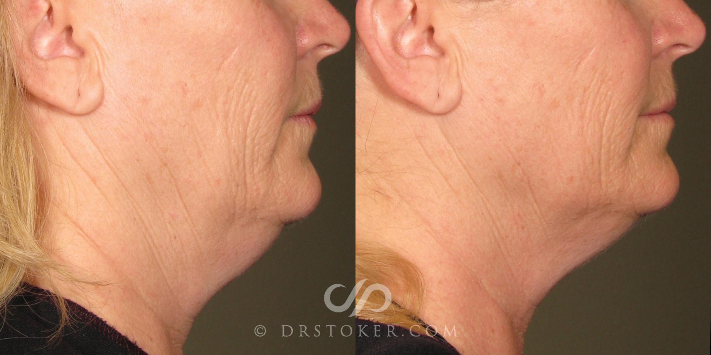 Before & After Ultherapy® Skin Tightening Case 1630 View #1 View in Marina del Rey, CA