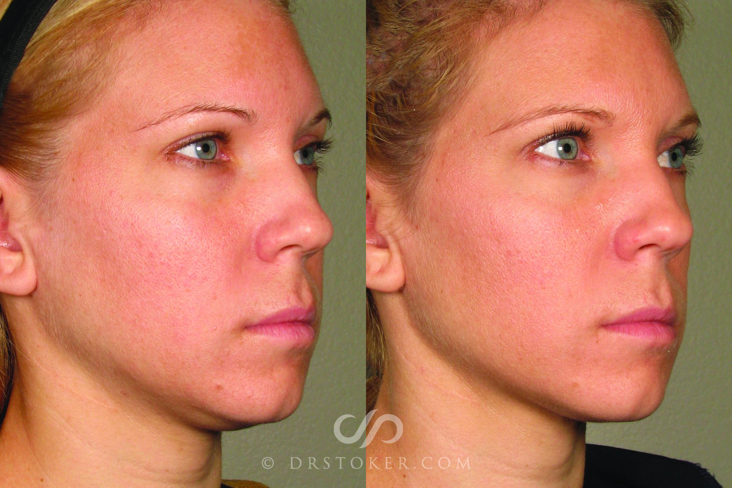 Before & After Ultherapy® Skin Tightening Case 1631 View #1 View in Marina del Rey, CA