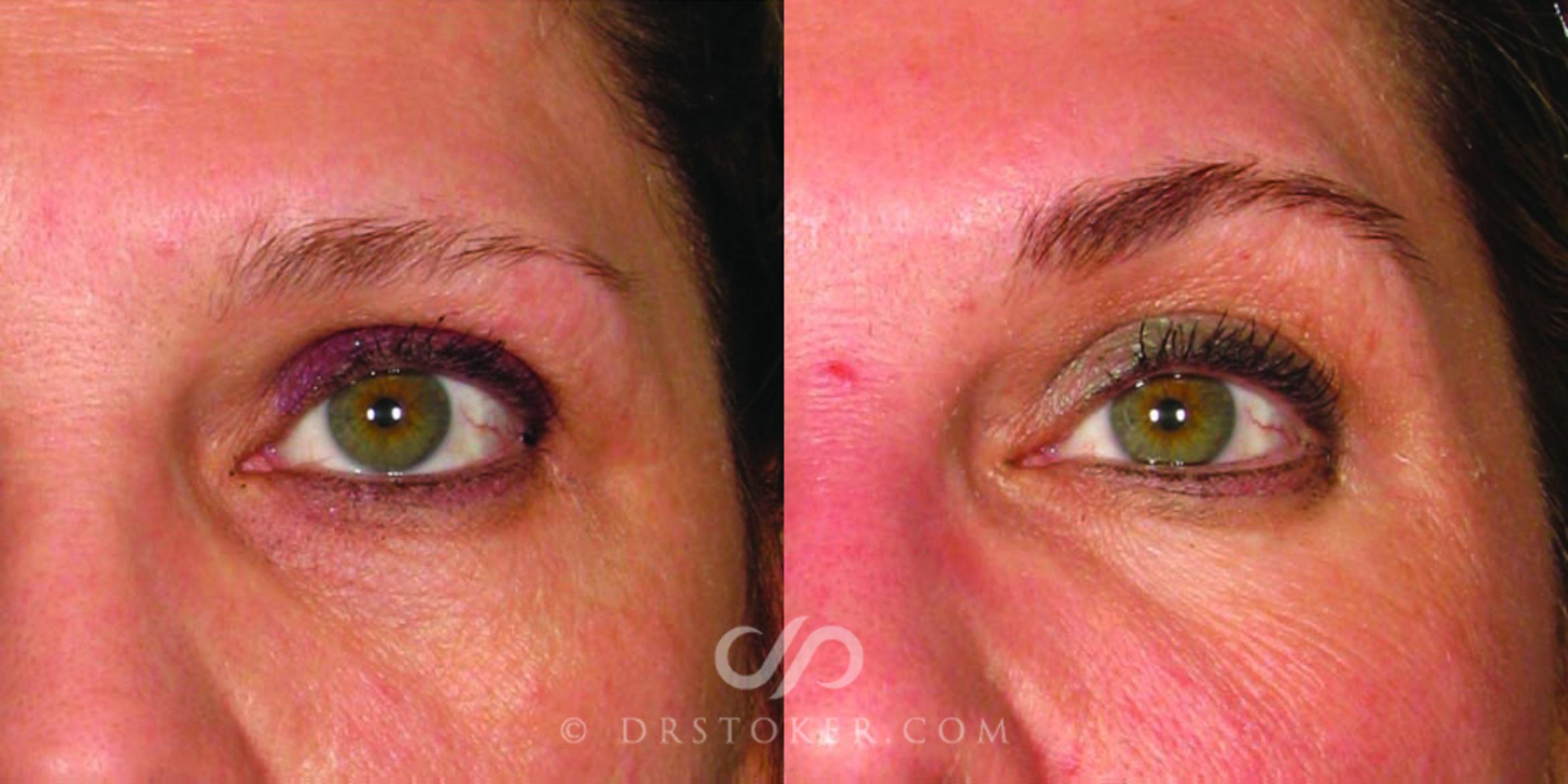 Before & After Ultherapy® Skin Tightening Case 1632 View #1 View in Marina del Rey, CA