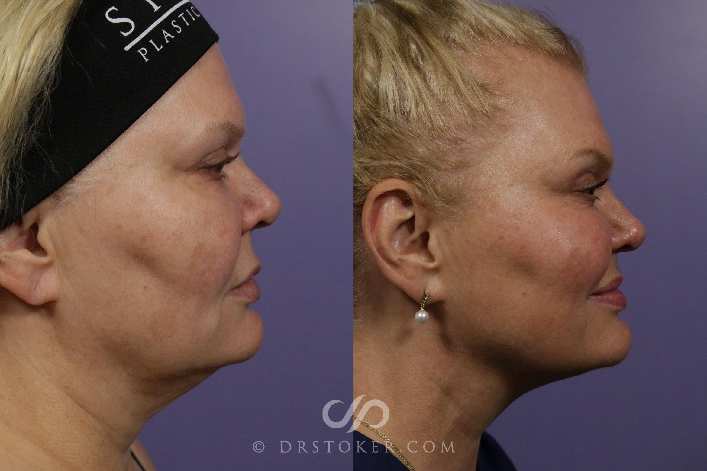 Before & After Ultherapy® Skin Tightening Case 1973 Right Side View in Marina del Rey, CA