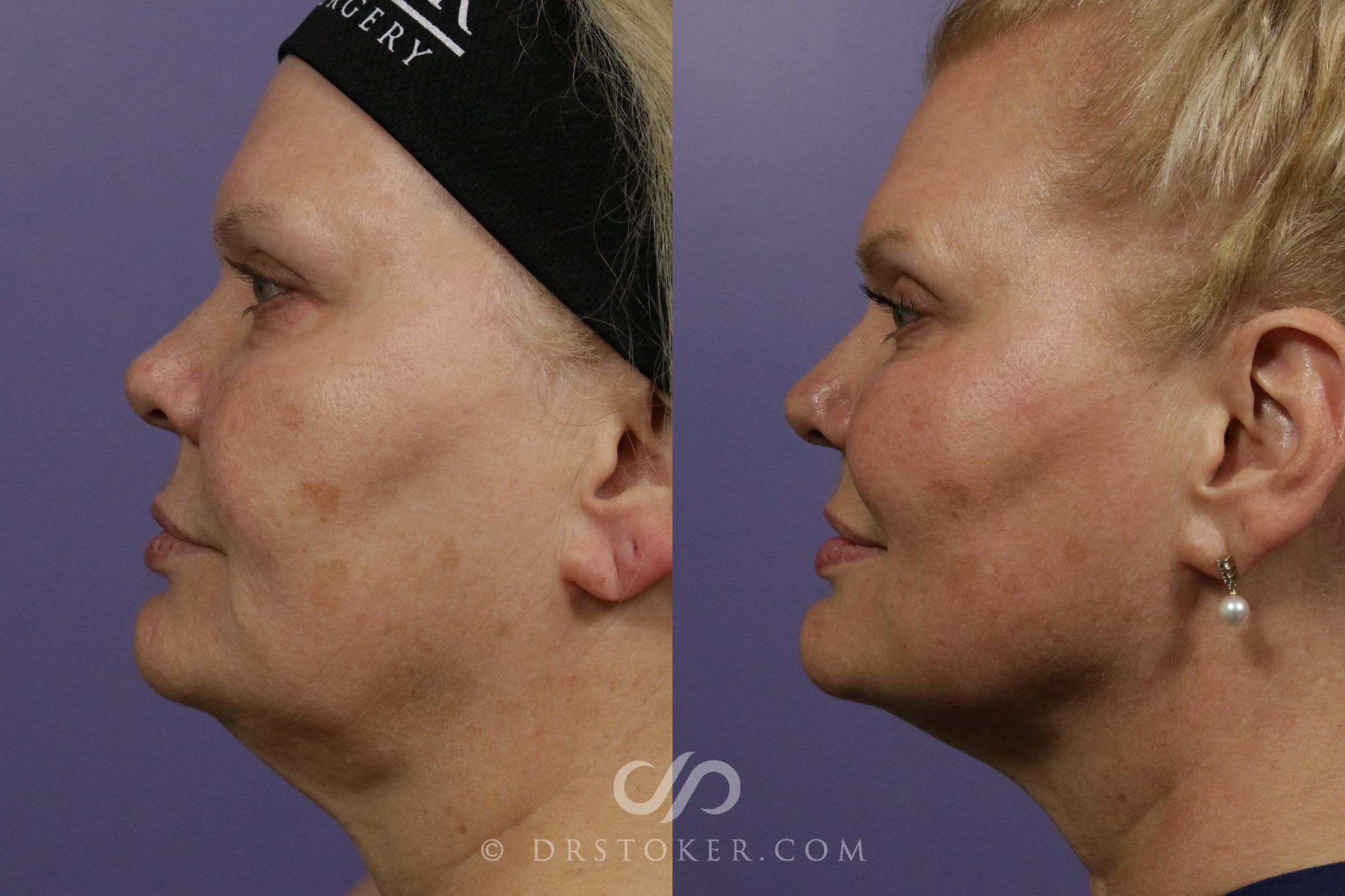 Before & After Ultherapy® Skin Tightening Case 1974 Left Side View in Marina del Rey, CA