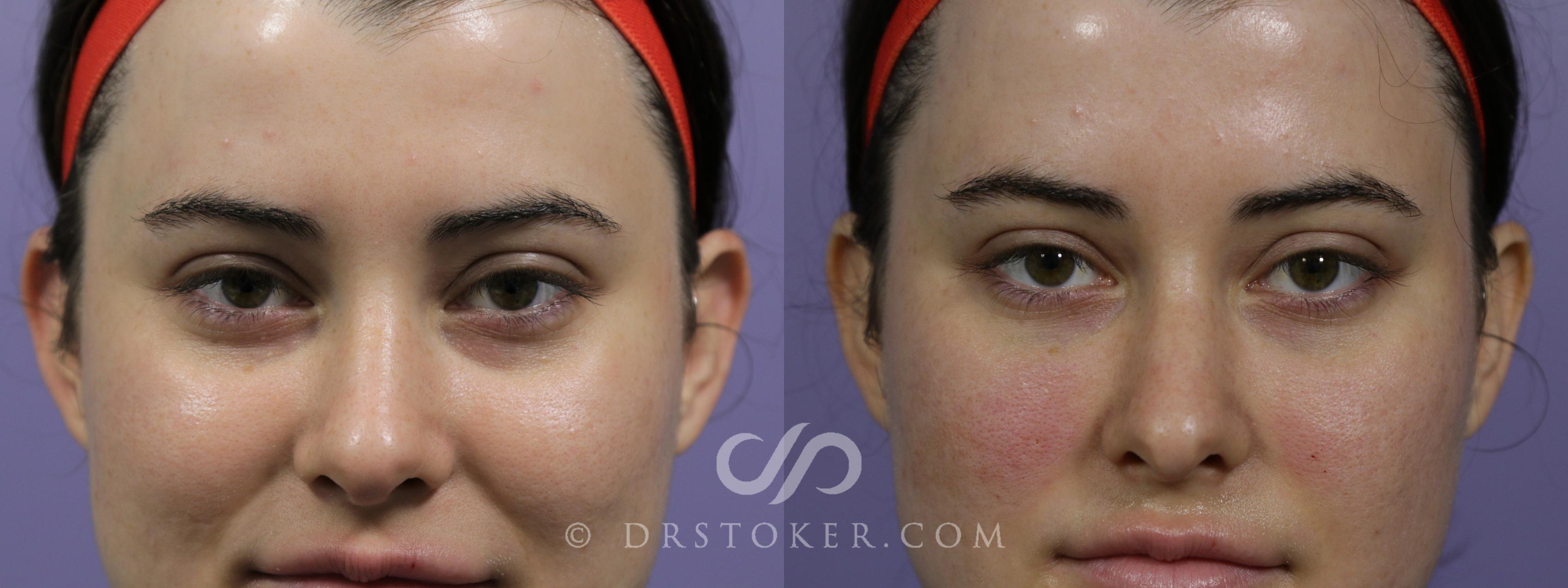 Before & After Undereye Fillers Case 1577 View #1 View in Los Angeles, CA