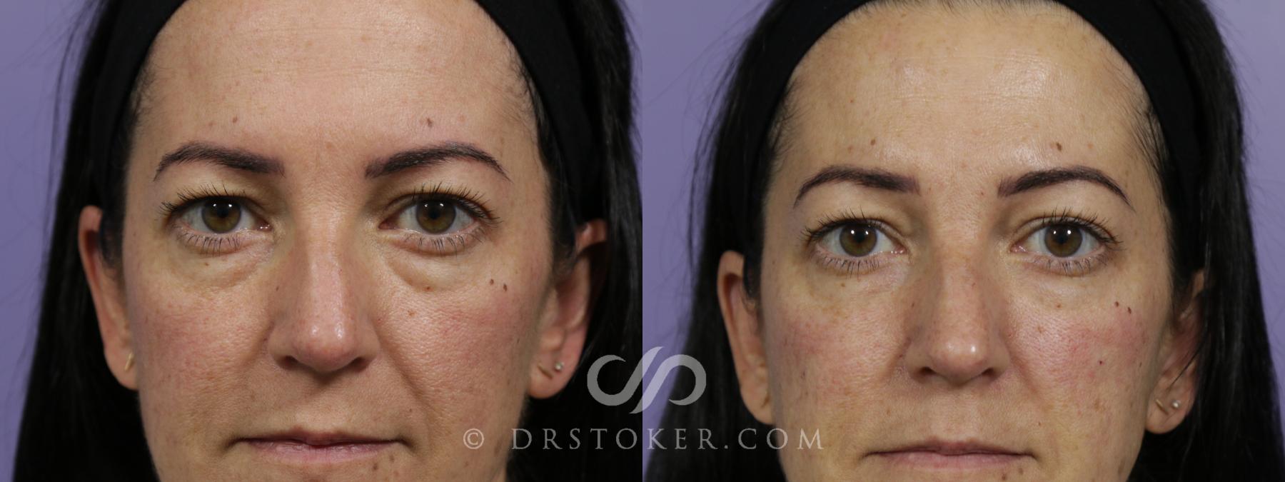 Before & After Facial Fillers Case 1578 View #1 View in Los Angeles, CA