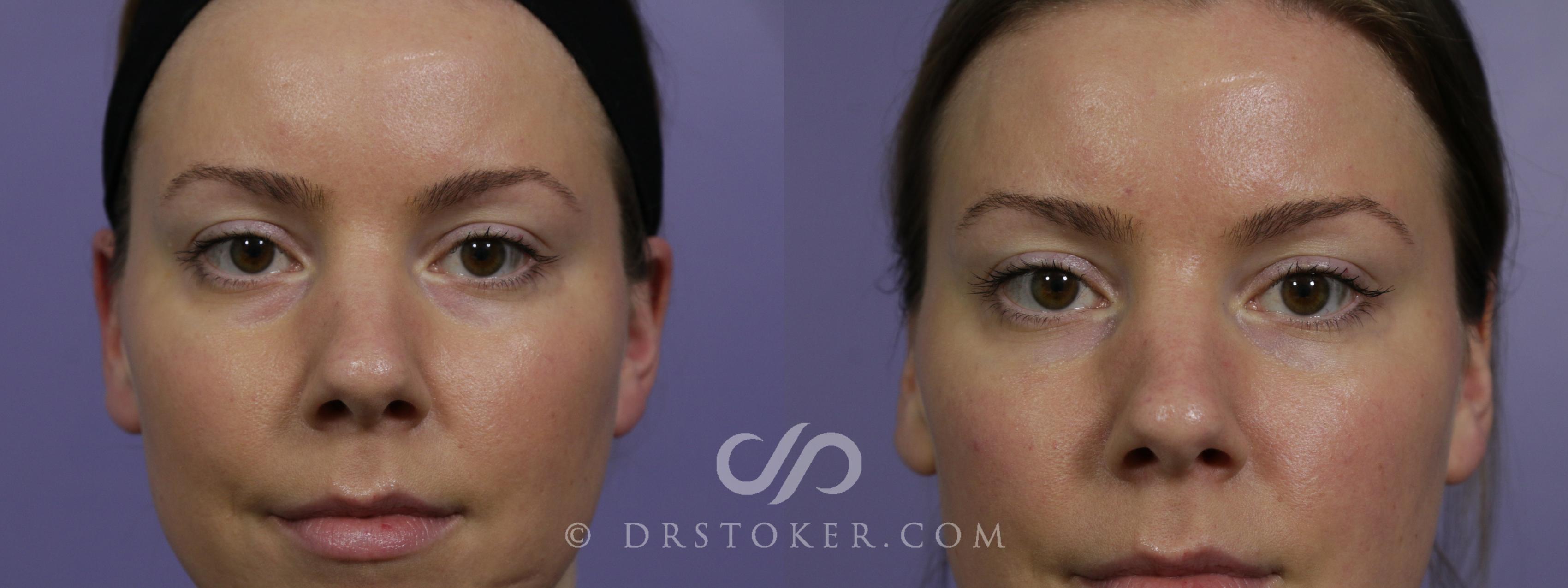 Before & After Undereye Fillers Case 1595 View #1 View in Los Angeles, CA
