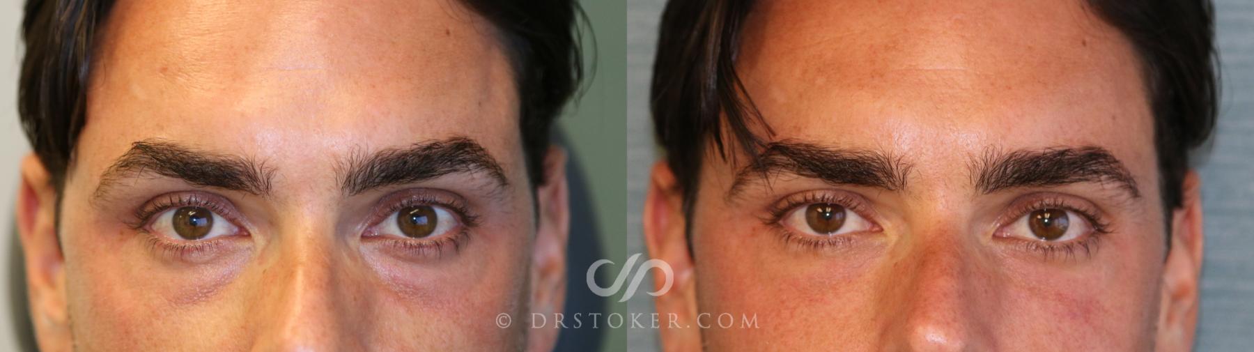 Before & After Facial Fillers Case 1596 View #1 View in Los Angeles, CA