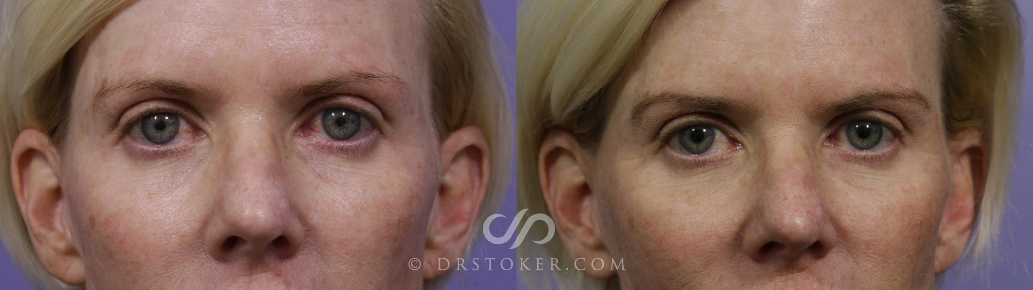 Before & After Undereye Fillers Case 1605 View #1 View in Los Angeles, CA