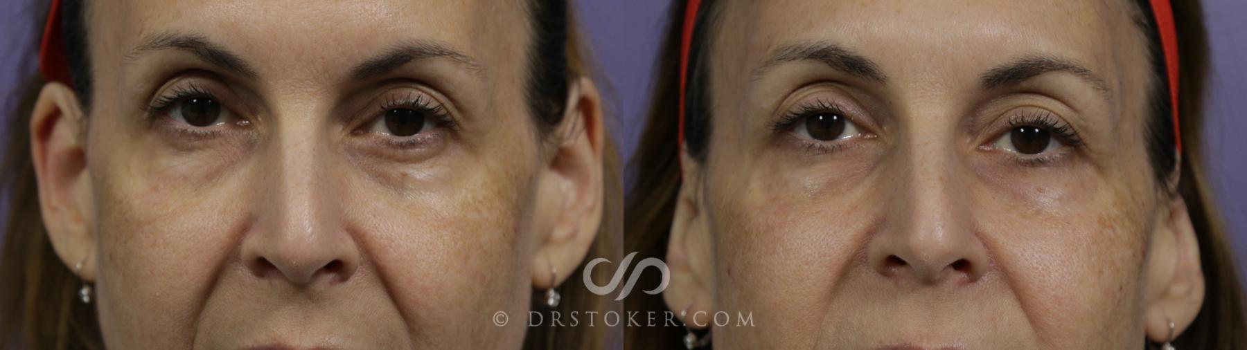 Before & After Undereye Fillers Case 1608 View #1 View in Los Angeles, CA
