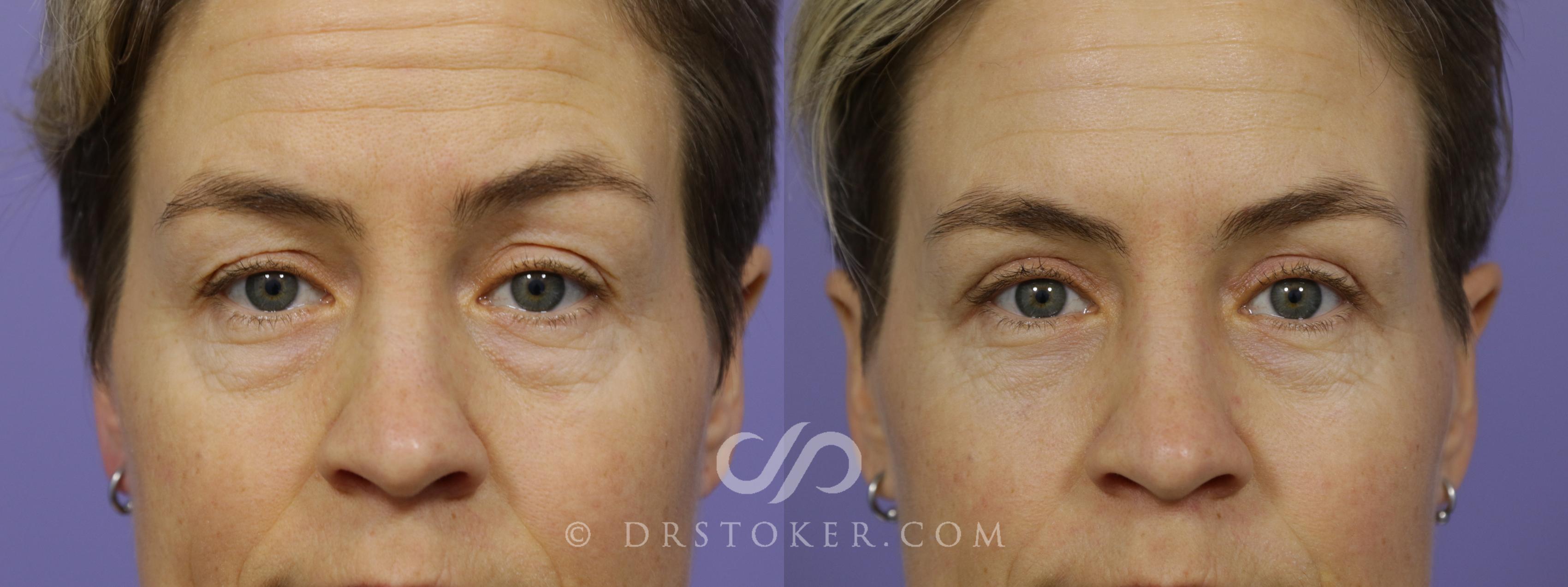 Before & After Undereye Fillers Case 1611 View #1 View in Los Angeles, CA