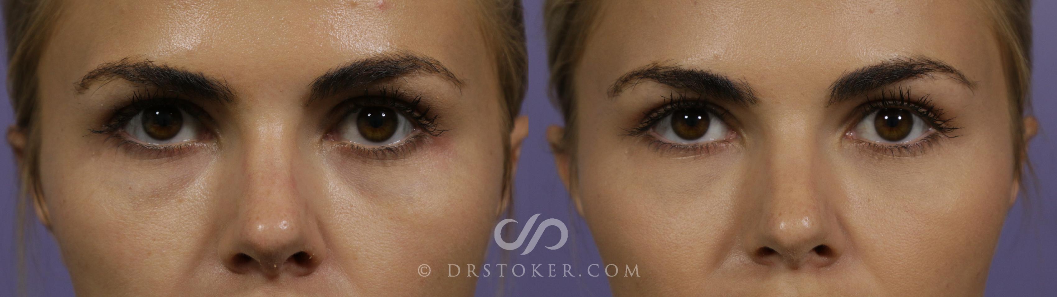 Before & After Undereye Fillers Case 1619 View #1 View in Los Angeles, CA