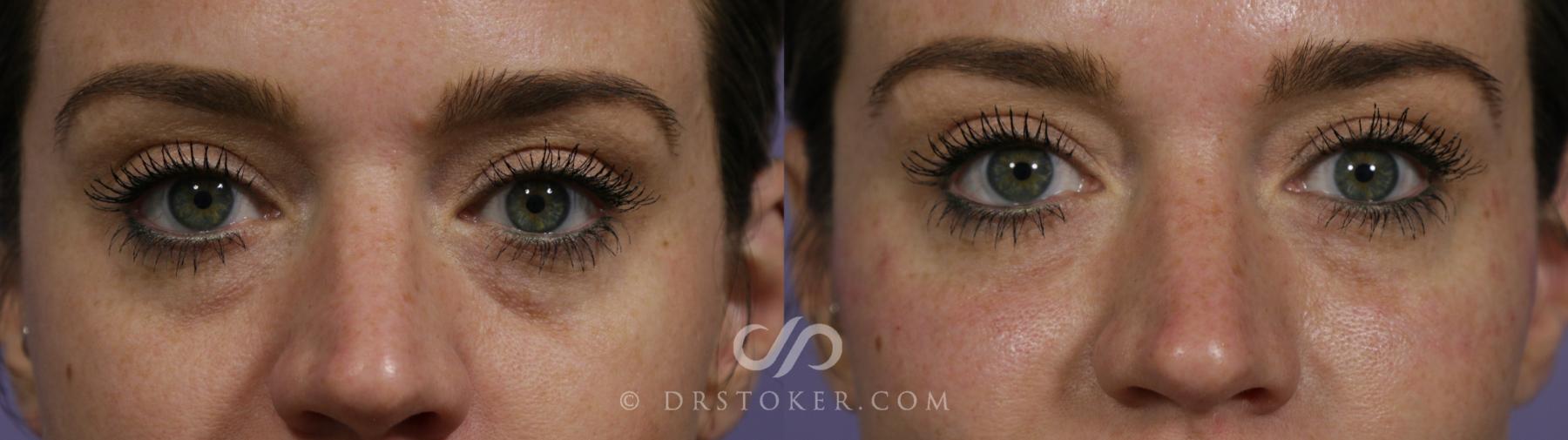 Before & After Undereye Fillers Case 1621 View #1 View in Los Angeles, CA