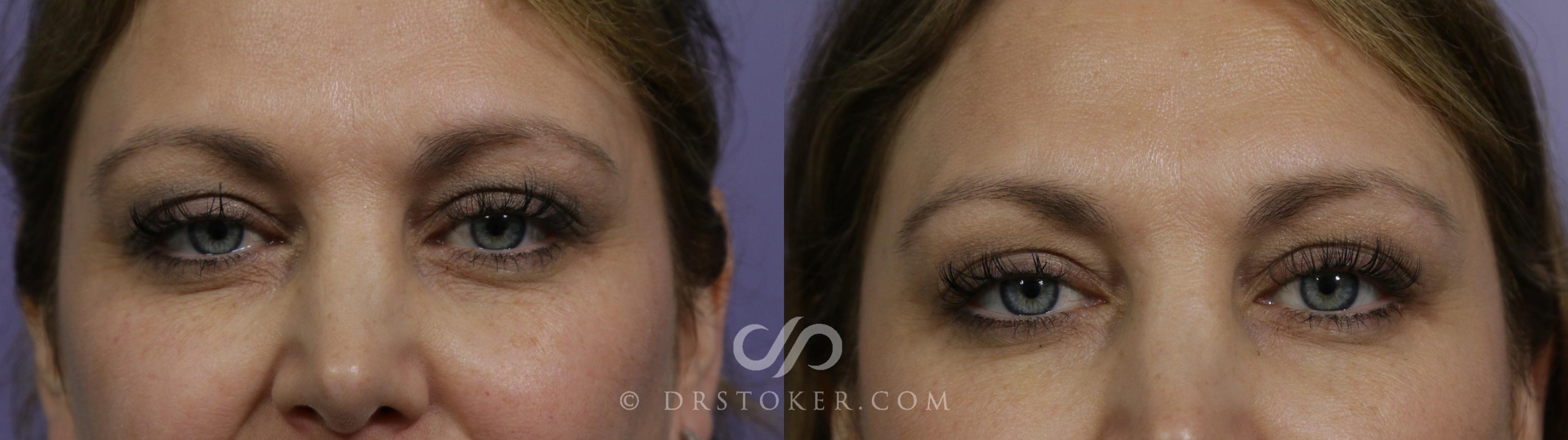 Before & After Undereye Fillers Case 1624 View #1 View in Los Angeles, CA
