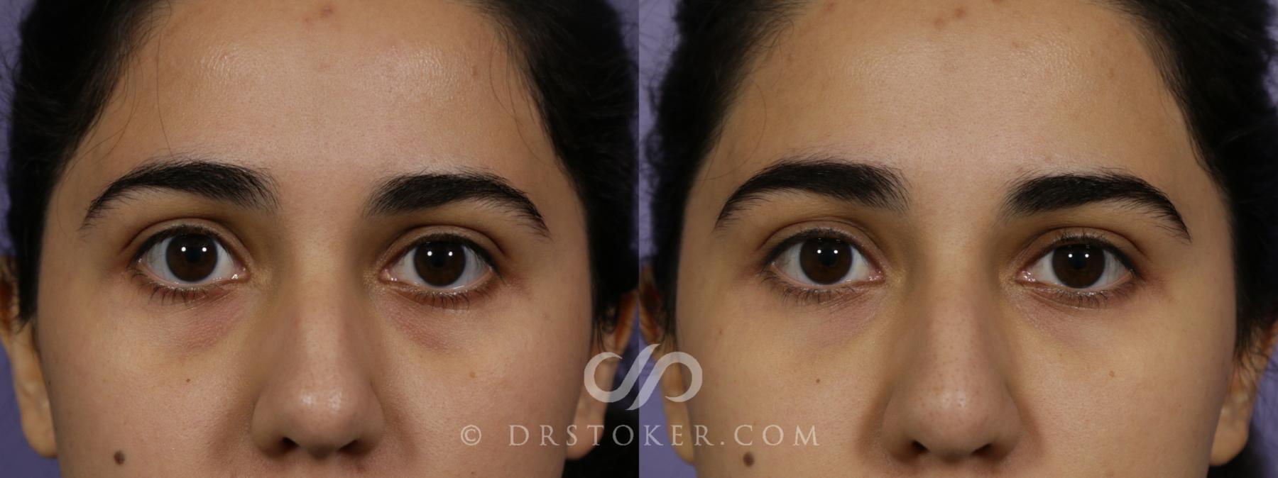 Before & After Undereye Fillers Case 1641 View #1 View in Los Angeles, CA