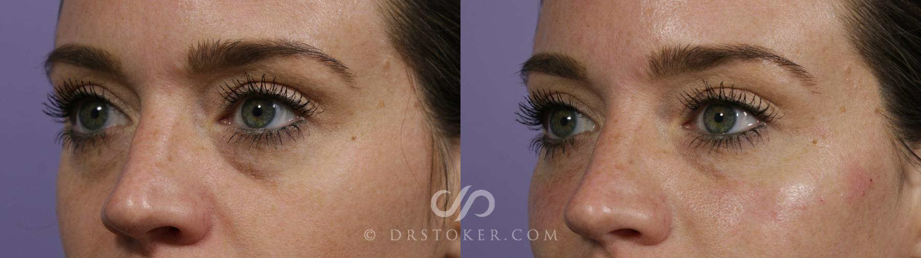 Before & After Undereye Fillers Case 1648 View #1 View in Los Angeles, CA