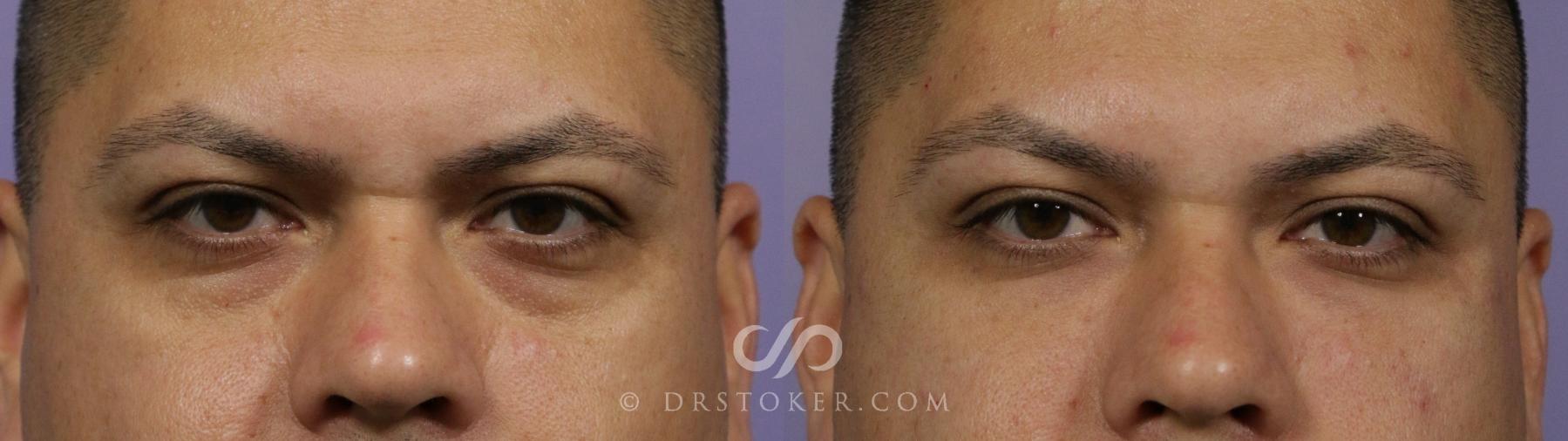 Before & After Undereye Fillers Case 1852 Front View in Los Angeles, CA