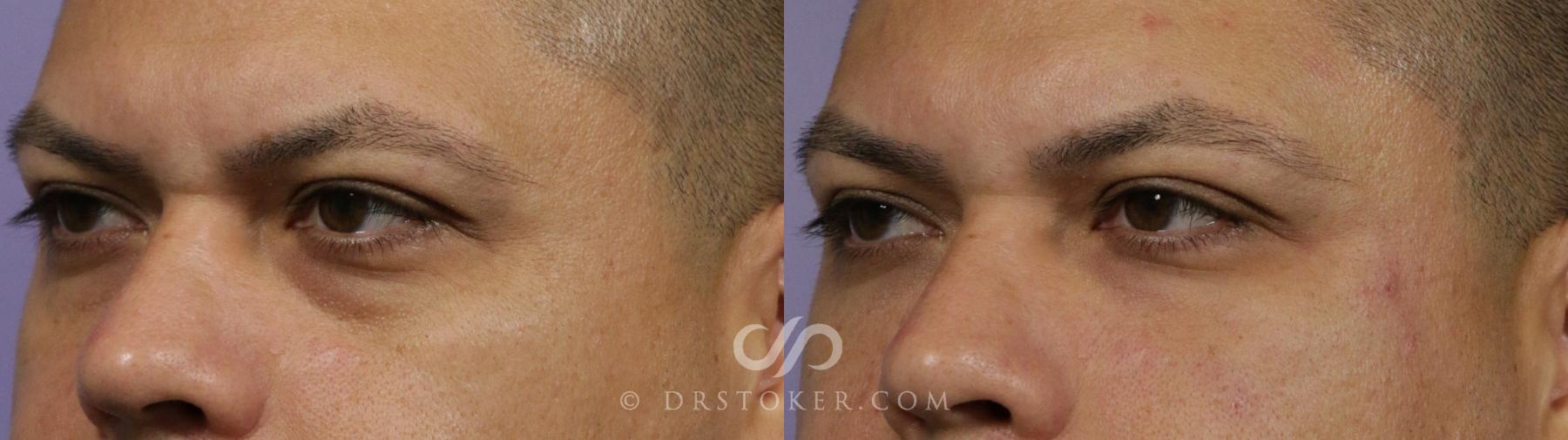 Before & After Undereye Fillers Case 1852 Left Oblique View in Los Angeles, CA