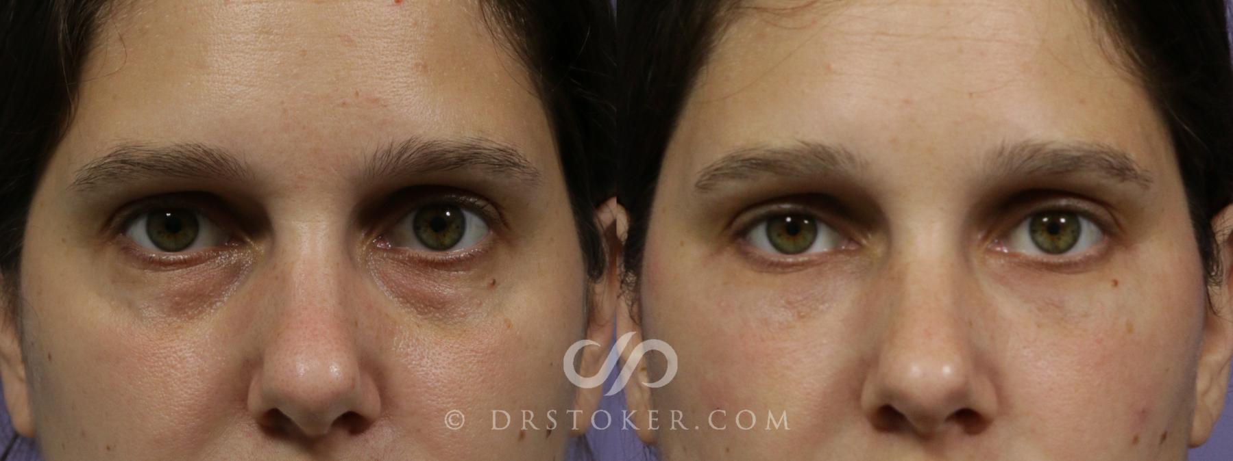 Before & After Undereye Fillers Case 1861 Front View in Los Angeles, CA