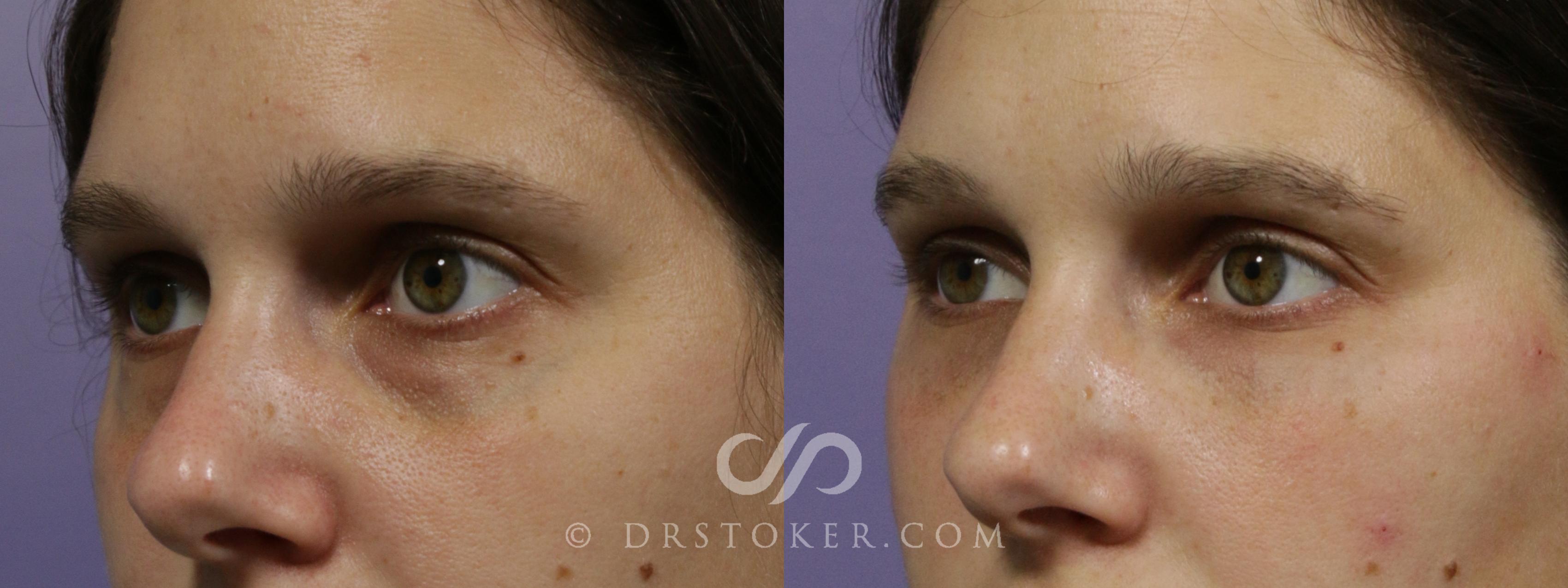 Before & After Undereye Fillers Case 1862 Left Oblique View in Los Angeles, CA