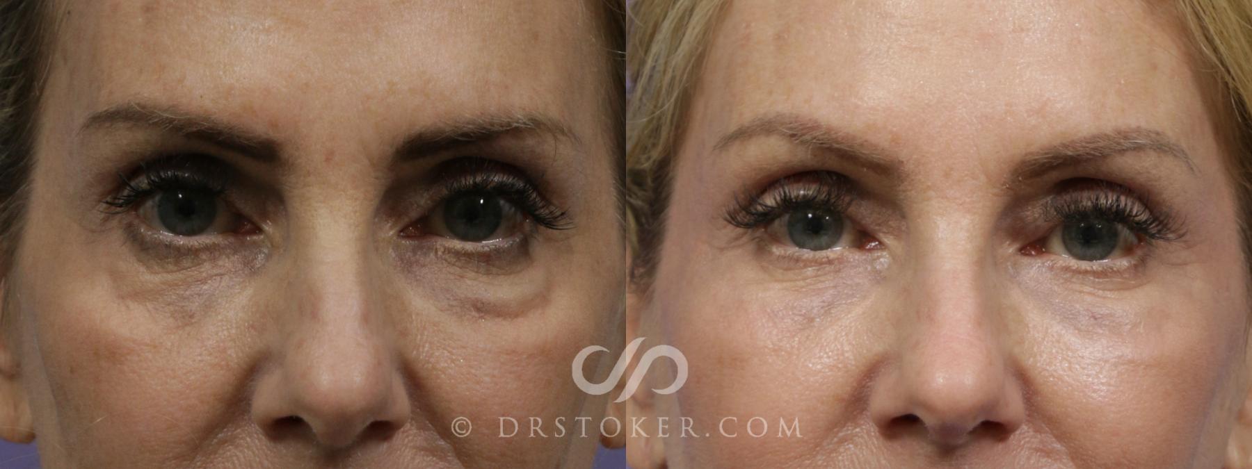 Before & After Undereye Fillers Case 1865 Front View in Los Angeles, CA