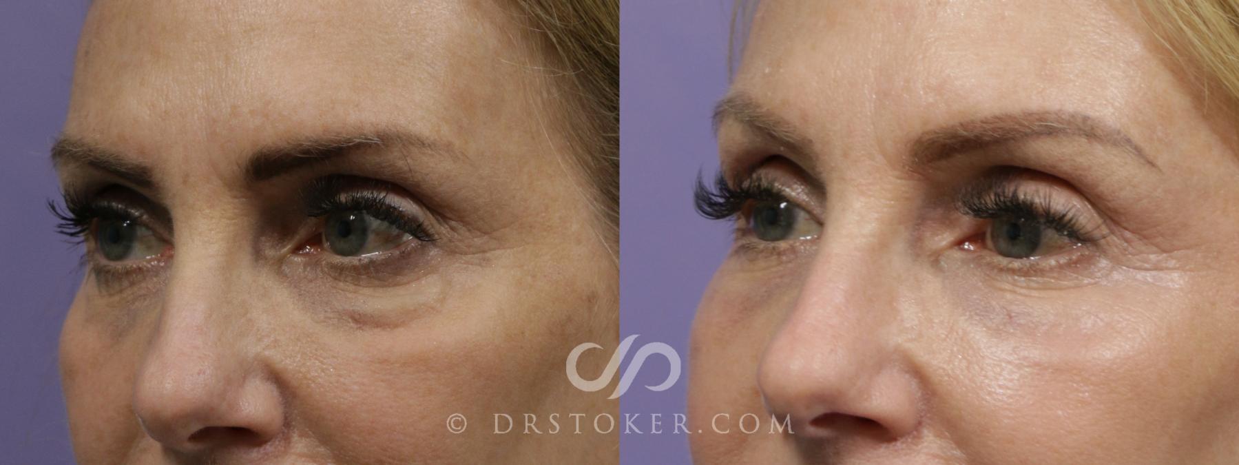 Before & After Undereye Fillers Case 1866 Left Oblique View in Los Angeles, CA