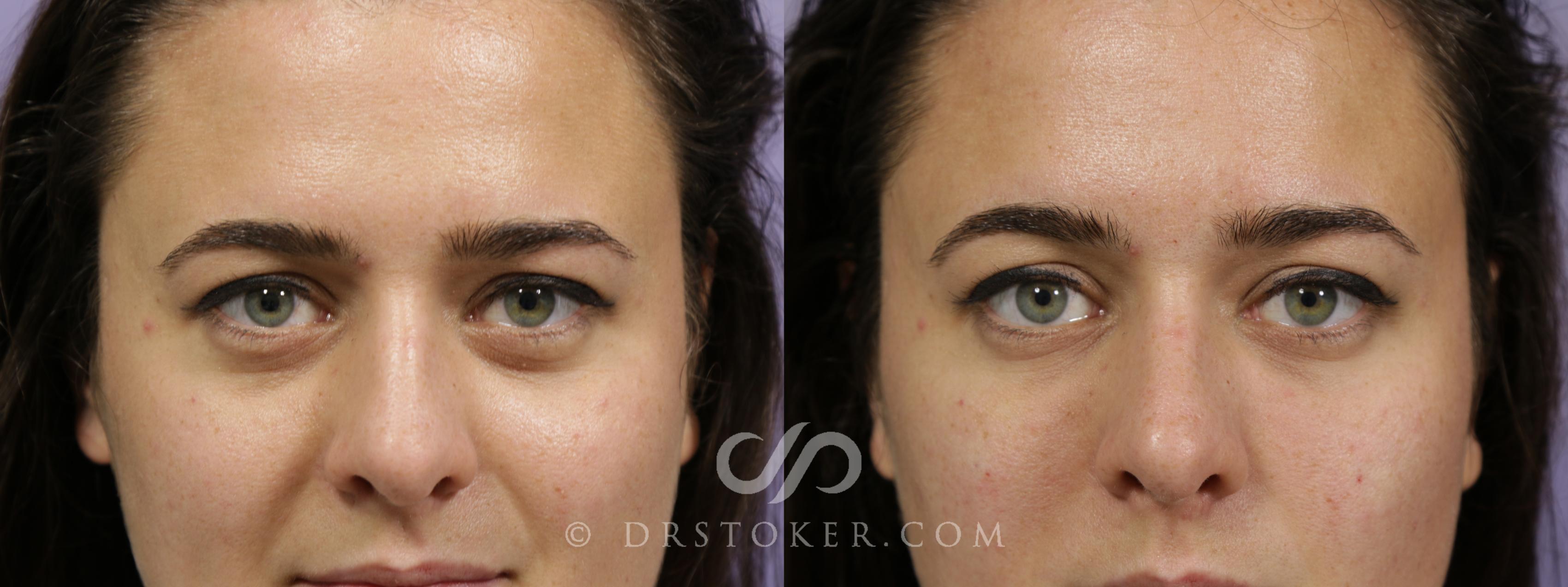 Before & After Undereye Fillers Case 1883 Front View in Los Angeles, CA