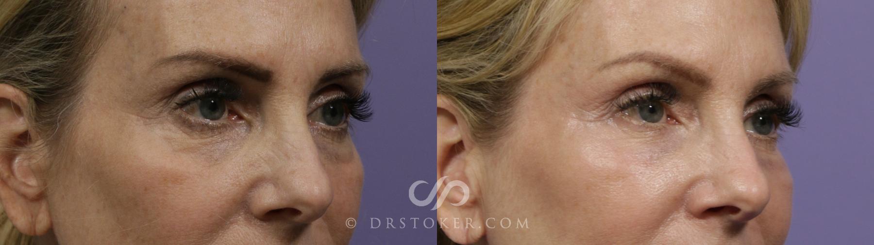 Before & After Undereye Fillers Case 2279 Right Oblique View in Los Angeles, CA