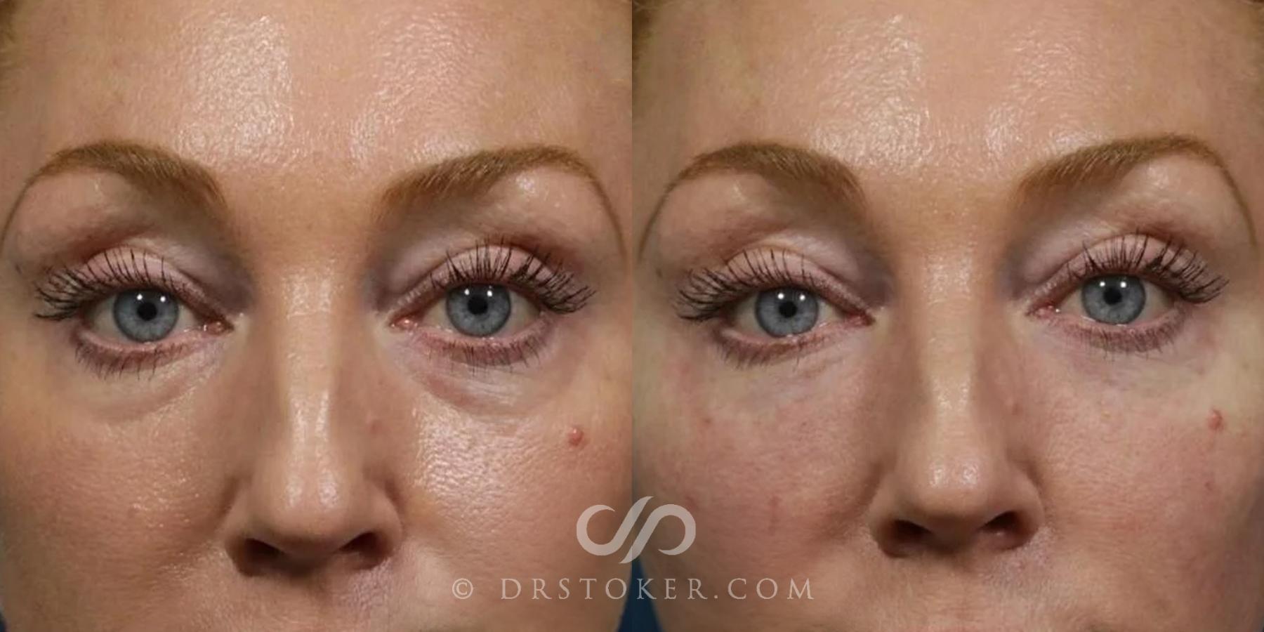 Before & After Undereye Fillers Case 2662 Front View in Los Angeles, CA